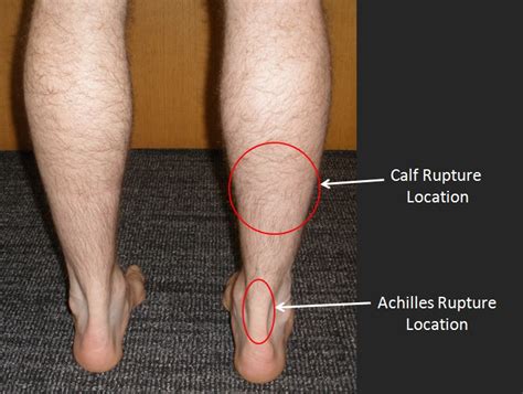 test for calf tear|how to diagnose torn calf muscle.